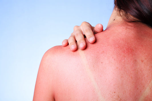 Sonnenbrand